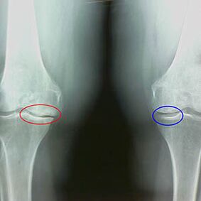 Artrose da articulação do joelho na radiografia