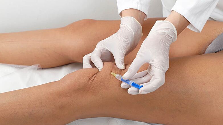 Injeção intra -articular para artrose do joelho