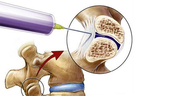 Bloqueio paravertebral para dor nas costas